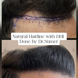 Every natural-looking result begins with a thoughtful design.

For this patient, the hairline was pl