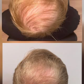 Not every transformation begins in the operating room.

This 33-year-old gentleman presented with on