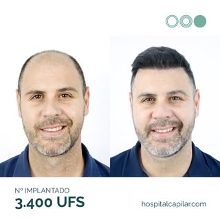 6 meses y ya con pelazo 🤩

Tan sólo ha pasado medio año de la cirugía de Víctor, y ya disfruta de e