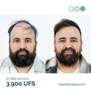 Este es el antes y después de Adrián tras el injerto capilar 🤯

💉Nuestro paciente decidió dar el p