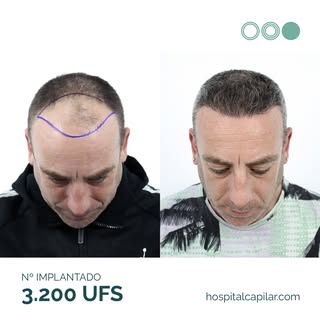 ✨ Resultados a los 12 meses del injerto capilar de Rubén ✨

Rubén presentaba una alopecia androgénic