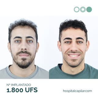 🩺 Redensificación de frontal a los 18 meses

David acudió a consulta con una alopecia androgenética