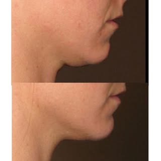 Rejuvenecer no siempre significa aportar volumen. 

En muchos casos, el objetivo es recuperar la fir