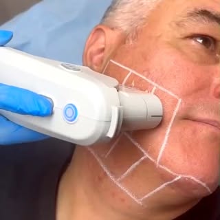 ¿Cómo funciona Ultherapy PRIME®?

Ultherapy utiliza tecnología de ultrasonidos microfocalizados con 
