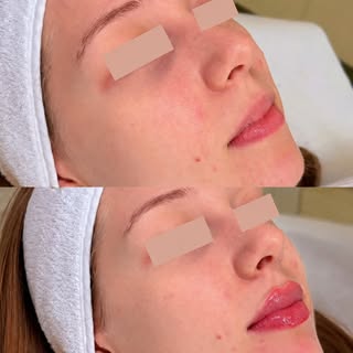 Antes y después de un aumento de labios con ácido hialurónico ✨

Más hidratación, mejor definición y