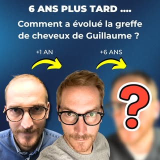 6 ans après sa greffe de cheveux : où en est réellement son résultat ?
Dans cette nouvelle vidéo tém