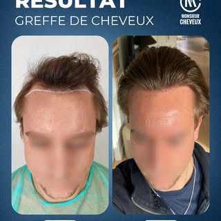 🎯 Objectif : À 26 ans, notre client souhaitait harmoniser sa ligne frontale et atténuer la profonde