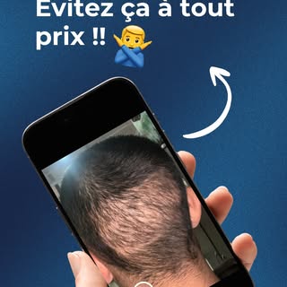 Pour lui, malheureusement, pas de retour en arrière possible … #greffecheveux #grefferatée #clinique