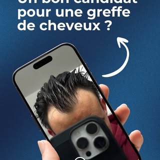 Un candidat à la greffe de cheveux qui s’est posé les bonnes questions, on aime ! 😁 #greffecheveux 