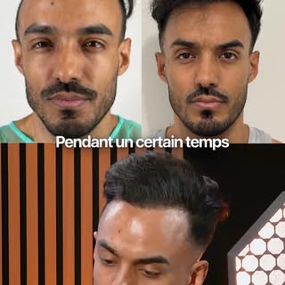 Jordan explique comment sa greffe de cheveux lui a permis de se réaligner avec lui-même #greffecheve