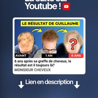 Avant d’envisager des traitements contre la perte de cheveux, demandez l’avis de votre médecin ou d’