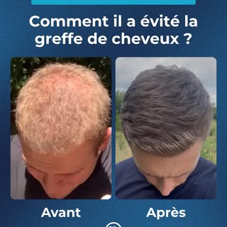 Avant d’envisager des traitements contre la perte de cheveux, demandez l’avis de votre médecin ou d’