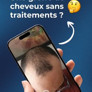 Est-ce une bonne idée d’envisager une greffe de cheveux sans prendre de traitements par la suite ? #