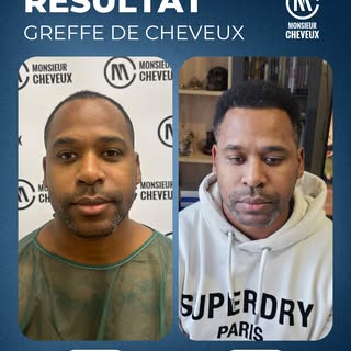 🎯 Objectif : À 38 ans, Cheick souhaitait retrouver une ligne frontale plus harmonieuse et atténuer 