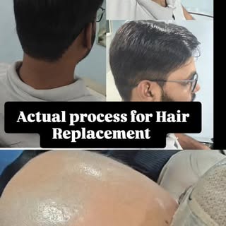 Non surgical hair replacement method so easy looks better