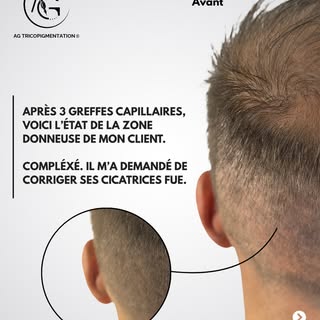 TRAITEMENT DE CICATRICE FUE POST GREFFE CAPILLAIRE 

Après 3 interventions de greffe capillaire (1 F