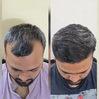 New hairline, New confidence — no filter, just results 🔥 #glowup #hairtransformation #confidenceboo