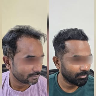 Hair transplant nahi lag raha? That’s the point ✨Result aisa ki close friends bhi notice na karein �