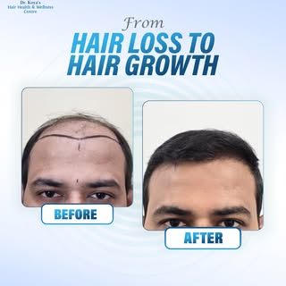 Real Results. Real Confidence. 💯

From visible hair loss to a naturally restored hairline—this tran