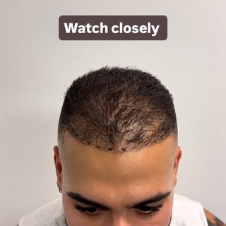 He got a hair transplant and still had low density 👎
We fixed it with SMP. Watch the difference.

#