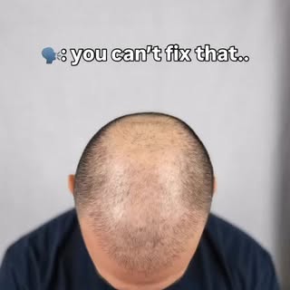 Apparently you can… #smp #scalpmicropigmentation #hairloss #beforeandafter #