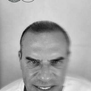 This #ScalpMicropigmentation procedure at @internationalhairlines addresses significant thinning acr