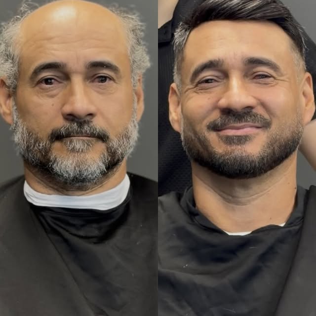 Olhem essa transformação!
Depois da prótese capilar, o visual mudou completamente: mais estilo, mais