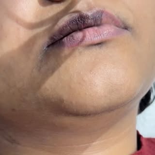 Dark lips holding back your confidence?
Discover our “**Laser Lip Peel**”, specially designed to red