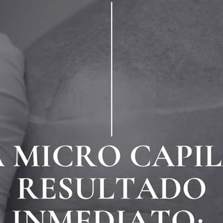 Nuestro cliente llegó con zonas de baja densidad capilar, con pérdida de cabello visible que afectab