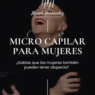 La micropigmentación capilar no es solo cosa de hombres.
·
Muchas mujeres con alopecia areata univer