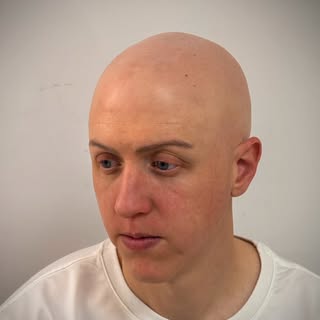 “La alopecia universal no solo cambia la apariencia, también puede poner a prueba la confianza. Con 