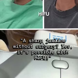 HIFU is one of the best non-surgical treatments to lift and define your jawline. It uses focused ult