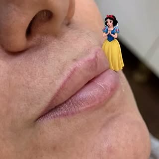 Lip Booster is a non-surgical injectable treatment that deeply hydrates and rejuvenates the lips rat