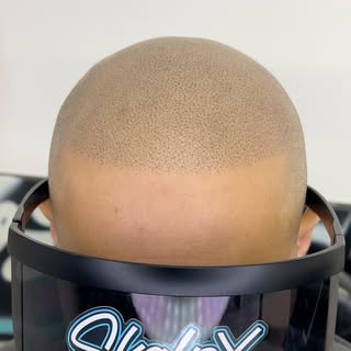 Slide over to see the before on this client! Blessed him with the “hybrid” hairline (soft edge up) l