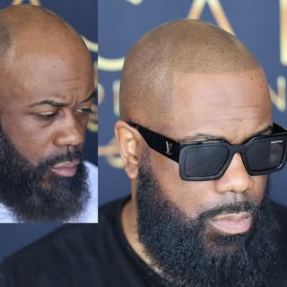 BEFORE AND AFTER 
Scalp Micropigmentation  done right for long term realistic results!