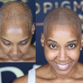 Scalp Micropigmentation for Women ✨

Look how amazing she looks with SMP!

If you're dealing with th