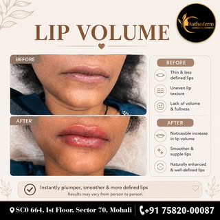 💋 Dreaming of fuller, beautifully defined lips?
Enhance your natural beauty with our Lip Volume Enh