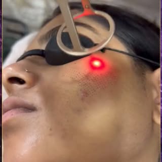 ✨ Acne may be gone, but the scars don't have to stay.

If acne scars are affecting your confidence, 