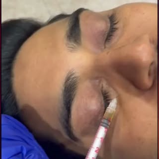 ✨ Tired of looking tired? Refresh your eyes with expert care!
Dark circles, under-eye hollows, fine 