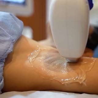 Smooth skin, minus the constant shaving and painful waxing.
Laser Hair Reduction helps reduce hair g