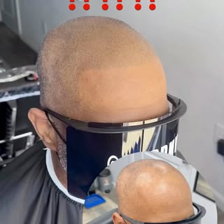Scalp Micro Pigmentation (SMP) is a permanent solution for hair loss of any kind; thinning, bald spo