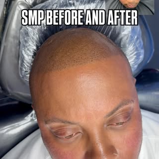 Scalp Micro Pigmentation (SMP) is a permanent solution for hair loss of any kind; thinning, bald spo