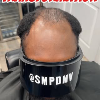 Scalp Micro Pigmentation (SMP) is a permanent solution for hair loss of any kind; thinning, bald spo