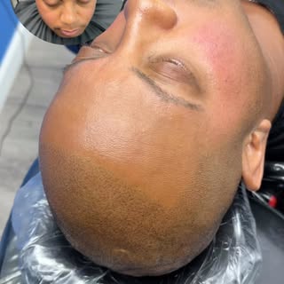 Scalp Micro Pigmentation (SMP) is a permanent solution for hair loss of any kind; thinning, bald spo