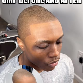 Scalp Micro Pigmentation (SMP) is a permanent solution for hair loss of any kind; thinning, bald spo