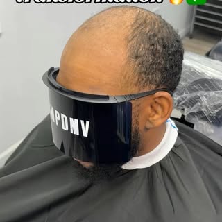 Scalp Micro Pigmentation (SMP) is a permanent solution for hair loss of any kind; thinning, bald spo