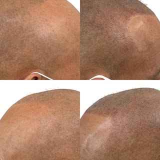 At Maxim Hair, we specialize in delivering Scalp Micropigmentation (SMP) treatments that are designe
