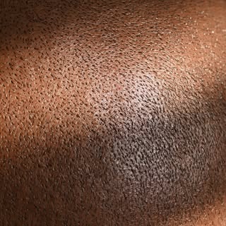 Scalp micropigmentation (SMP) works effectively for people of all skin colors by using specialized p