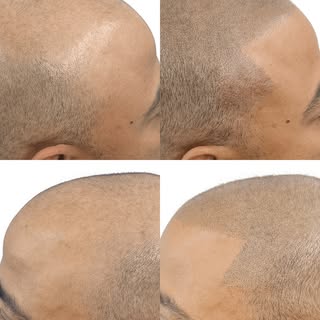 Scalp Micropigmentation (SMP) is most successful when it looks natural, balanced, and tailored to yo