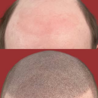 Scalp micropigmentation (SMP) can be a powerful way to enhance your facial aesthetics—when done with
